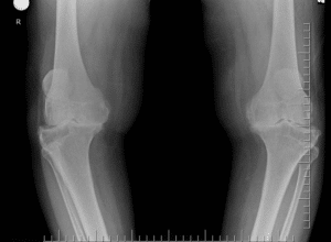 Bowlegged (Varus) Knee Arthritis
